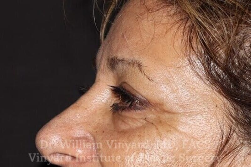 Eyelid Before & After Gallery - Patient 169744037 - Image 4