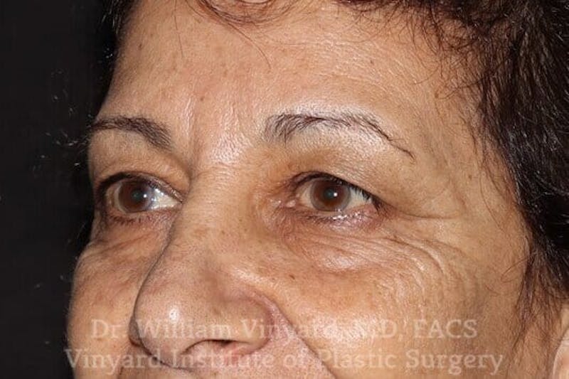 Eyelid Before & After Gallery - Patient 169744037 - Image 5