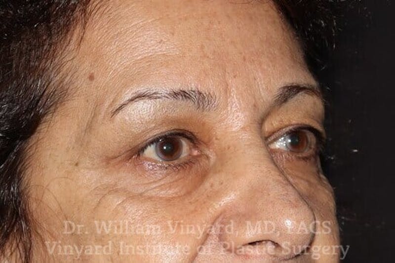 Eyelid Before & After Gallery - Patient 169744037 - Image 7