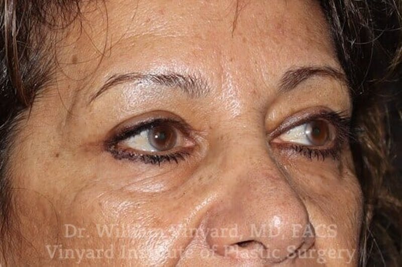 Eyelid Before & After Gallery - Patient 169744037 - Image 8