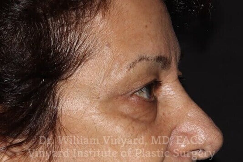Eyelid Before & After Gallery - Patient 169744037 - Image 9