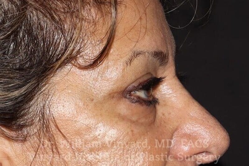 Eyelid Before & After Gallery - Patient 169744037 - Image 10