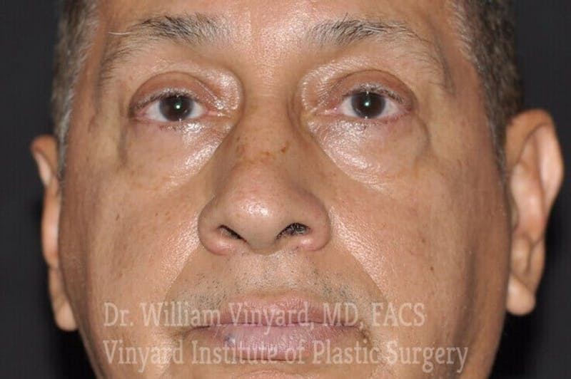 Eyelid Before & After Gallery - Patient 169744163 - Image 1