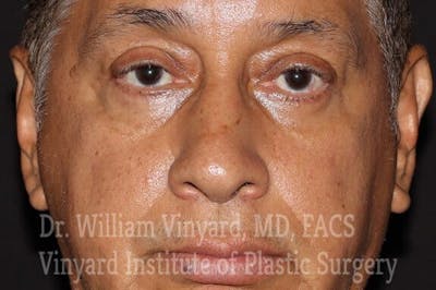 Eyelid Before & After Gallery - Patient 169744163 - Image 2
