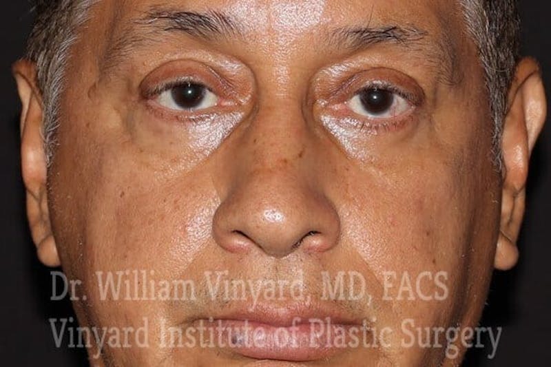 Eyelid Before & After Gallery - Patient 169744163 - Image 2
