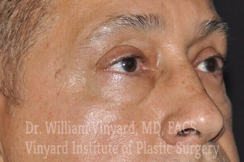 Eyelid Before & After Gallery - Patient 169744163 - Image 3