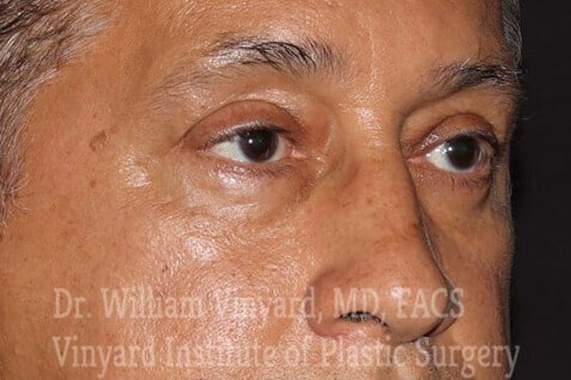 Eyelid Before & After Gallery - Patient 169744163 - Image 4