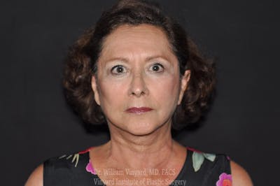 Eyelid Before & After Gallery - Patient 169744370 - Image 2