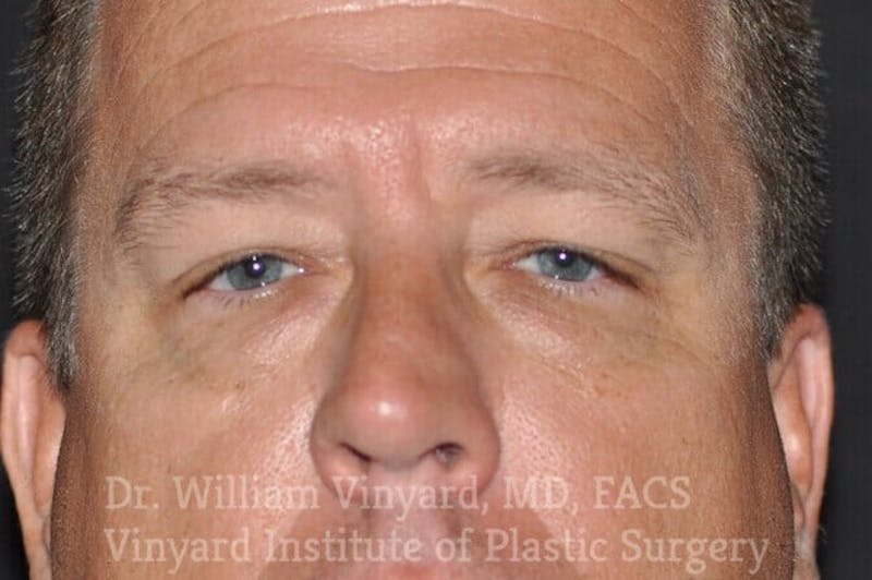 Eyelid Before & After Gallery - Patient 169744564 - Image 1