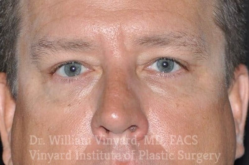 Eyelid Before & After Gallery - Patient 169744564 - Image 2