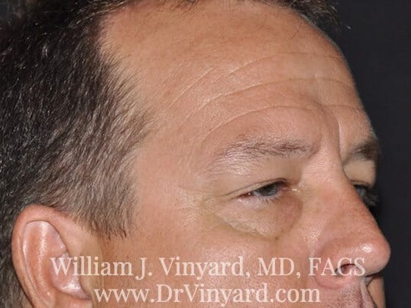 Eyelid Before & After Gallery - Patient 169744564 - Image 3