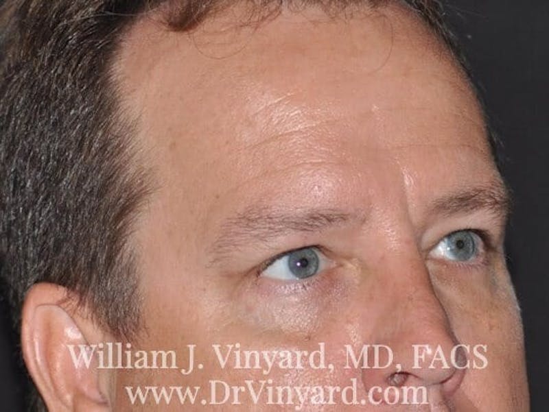 Eyelid Before & After Gallery - Patient 169744564 - Image 4