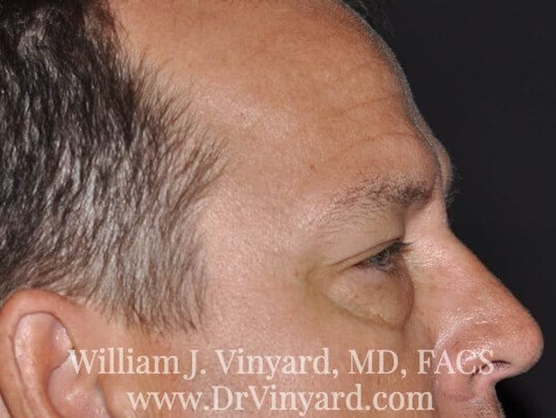 Eyelid Before & After Gallery - Patient 169744564 - Image 5