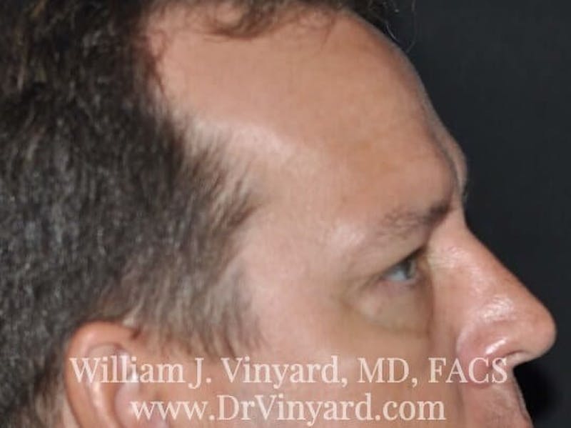 Eyelid Before & After Gallery - Patient 169744564 - Image 6
