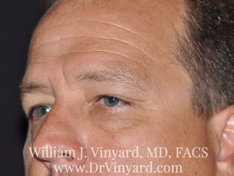 Eyelid Before & After Gallery - Patient 169744564 - Image 7
