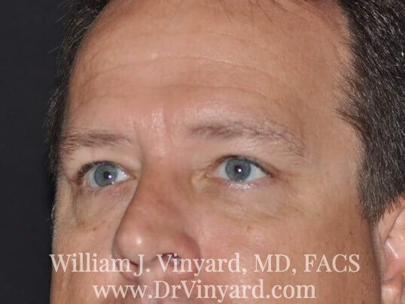 Eyelid Before & After Gallery - Patient 169744564 - Image 8