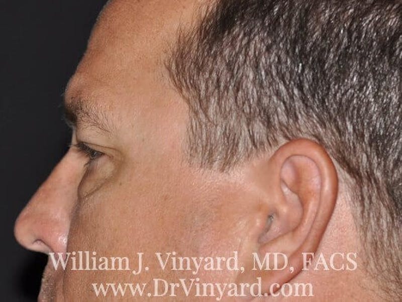 Eyelid Before & After Gallery - Patient 169744564 - Image 9