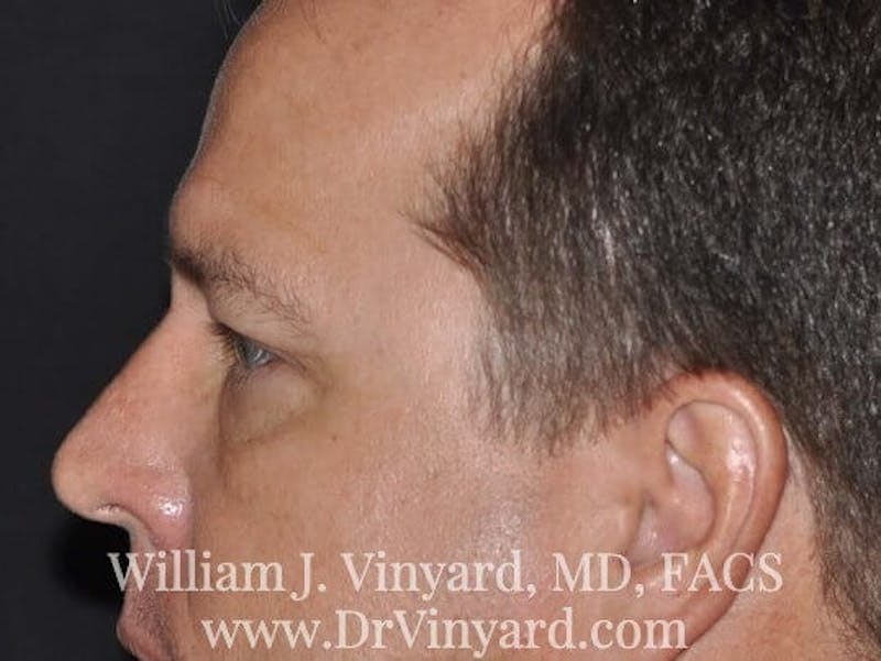 Eyelid Before & After Gallery - Patient 169744564 - Image 10