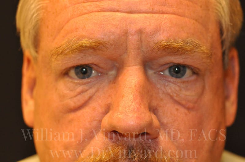 Eyelid Before & After Gallery - Patient 169744565 - Image 1