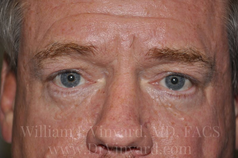 Eyelid Before & After Gallery - Patient 169744565 - Image 2