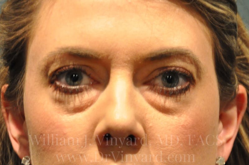 Eyelid Before & After Gallery - Patient 169744566 - Image 1