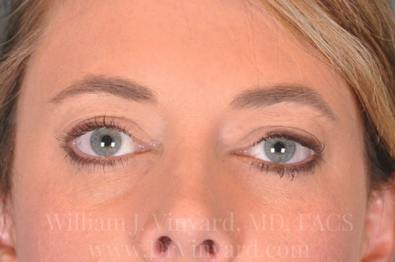 Eyelid Before & After Gallery - Patient 169744566 - Image 2