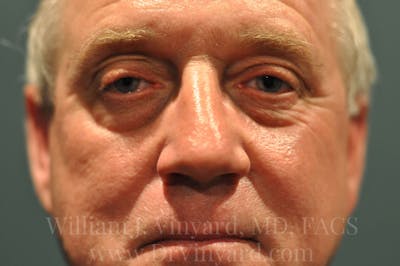 Eyelid Before & After Gallery - Patient 169744568 - Image 1