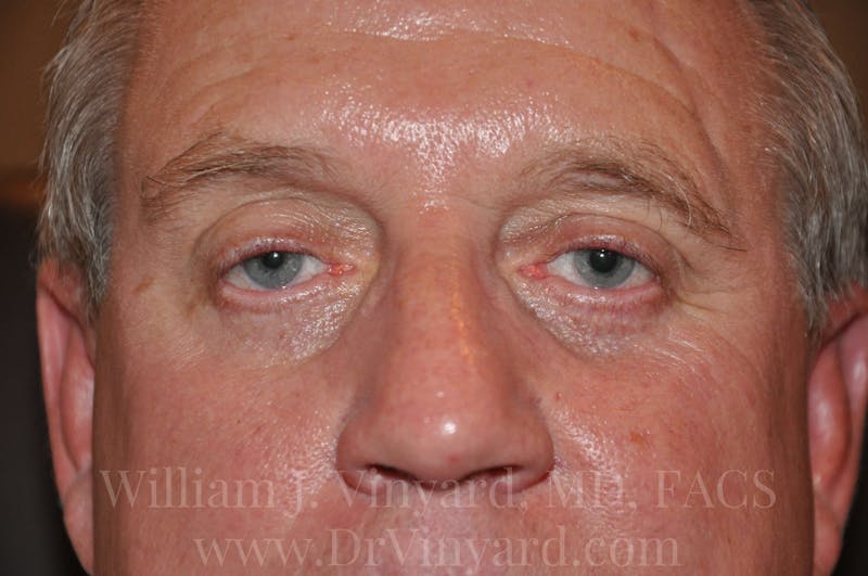 Eyelid Before & After Gallery - Patient 169744568 - Image 2