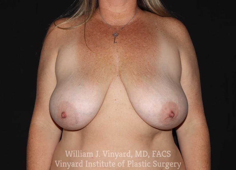 Breast Implant Removal Before & After Gallery - Patient 169745190 - Image 1