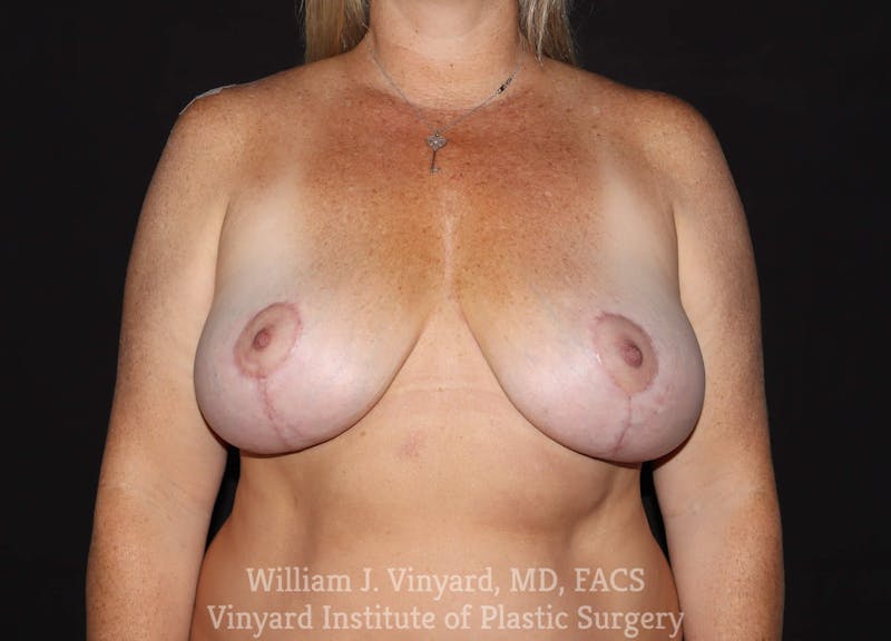 Breast Implant Removal Before & After Gallery - Patient 169745190 - Image 2