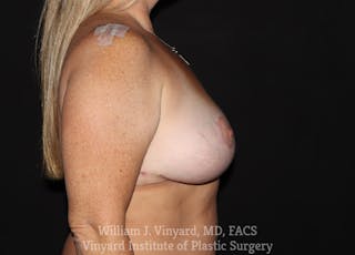 Breast Implant Removal Before & After Gallery - Patient 169745190 - Image 4