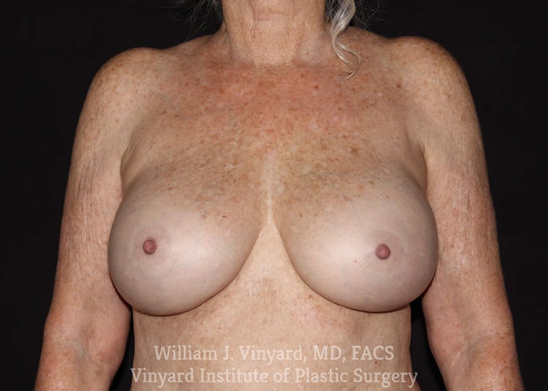 Breast Implant Removal Before & After Gallery - Patient 169745200 - Image 1