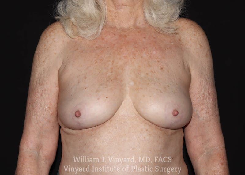Breast Implant Removal Before & After Gallery - Patient 169745200 - Image 2