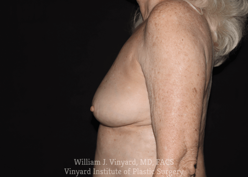 Breast Implant Removal Before & After Gallery - Patient 169745200 - Image 6