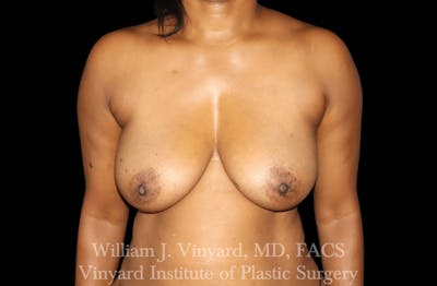 Breast Lift Before & After Gallery - Patient 169745741 - Image 1