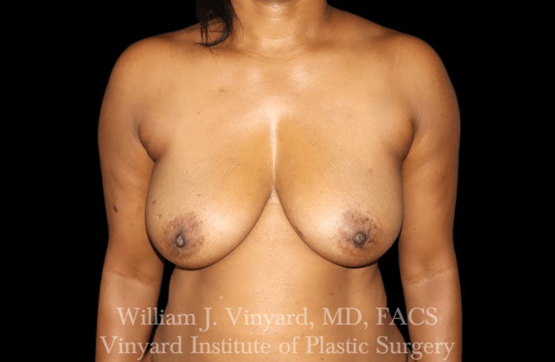 Breast Lift Before & After Gallery - Patient 169745741 - Image 1