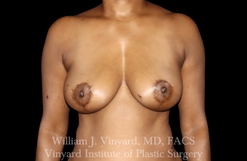 Breast Lift Before & After Gallery - Patient 169745741 - Image 2