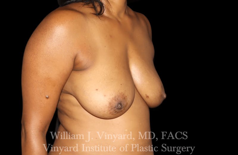 Breast Lift Before & After Gallery - Patient 169745741 - Image 3