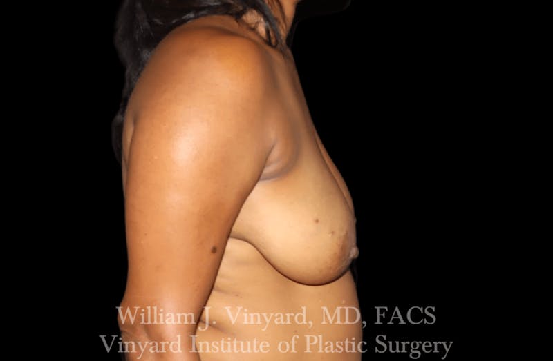 Breast Lift Before & After Gallery - Patient 169745741 - Image 5