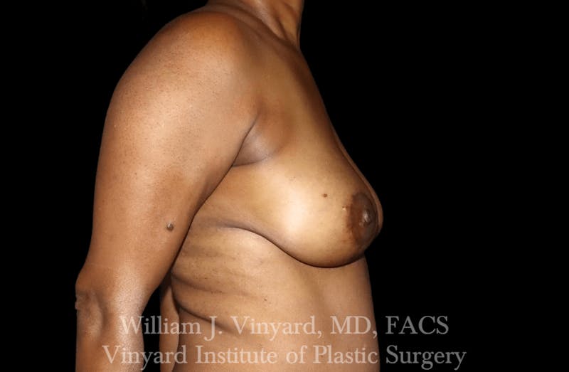 Breast Lift Before & After Gallery - Patient 169745741 - Image 6