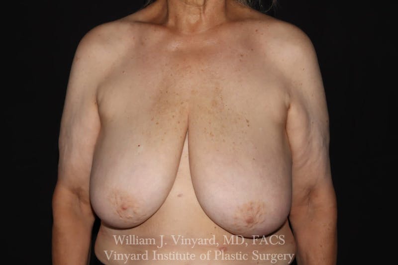 Breast Lift Before & After Gallery - Patient 169745743 - Image 1