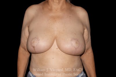 Breast Lift Before & After Gallery - Patient 169745743 - Image 2