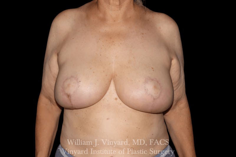 Breast Lift Before & After Gallery - Patient 169745743 - Image 2