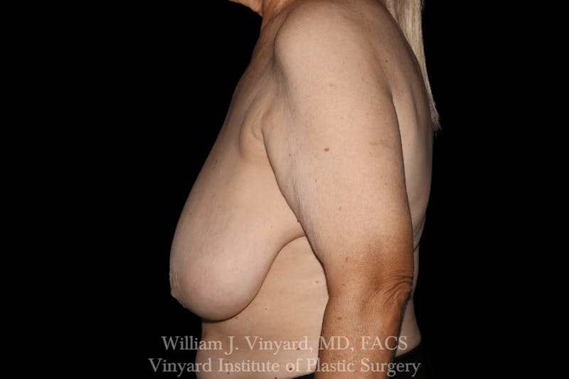 Breast Lift Before & After Gallery - Patient 169745743 - Image 5