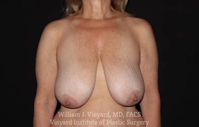 Breast Lift Before & After Gallery - Patient 169745746 - Image 1
