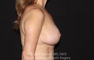 Breast Lift Before & After Gallery - Patient 169745746 - Image 6