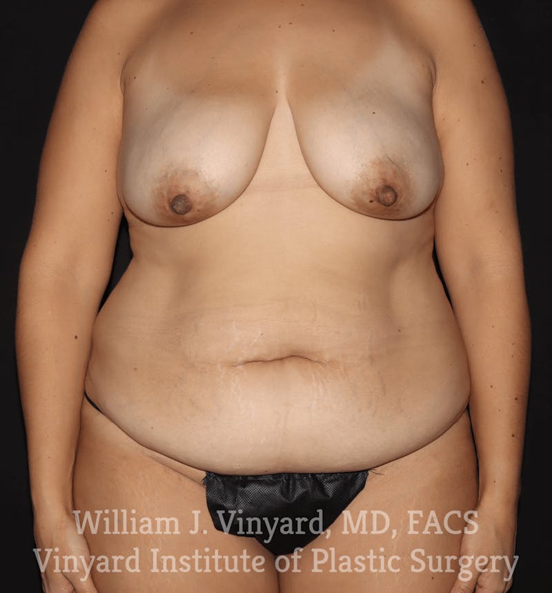 Breast Lift Before & After Gallery - Patient 169746166 - Image 1