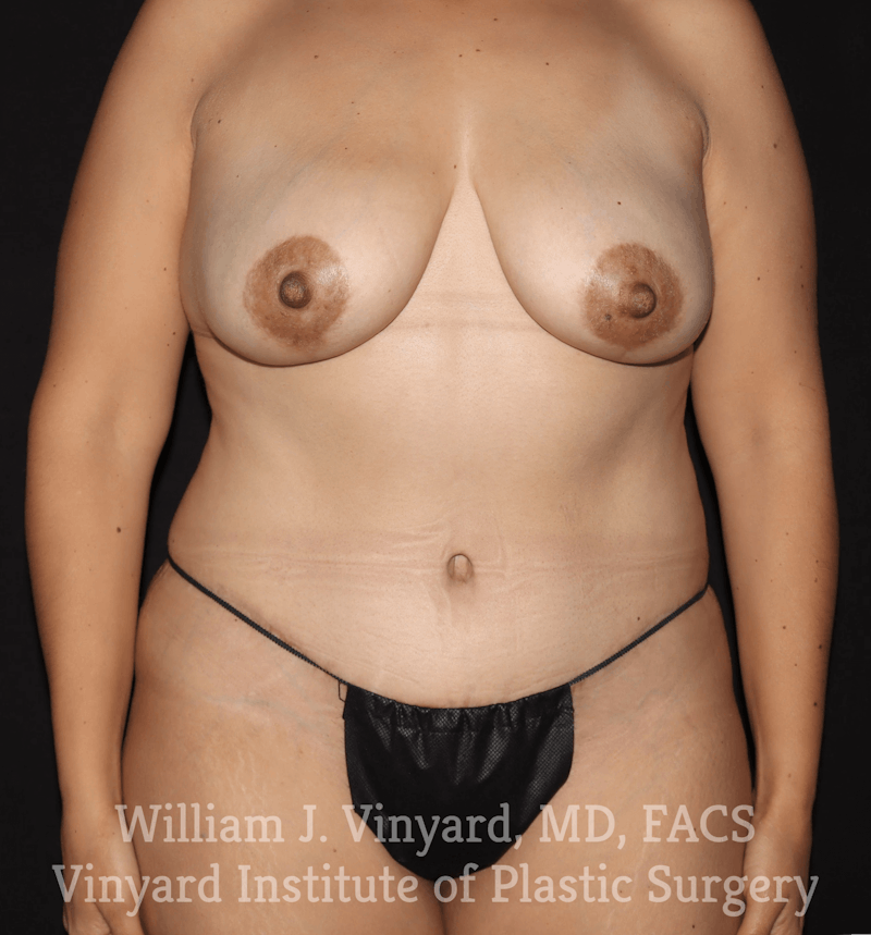 Breast Lift Before & After Gallery - Patient 169746166 - Image 2
