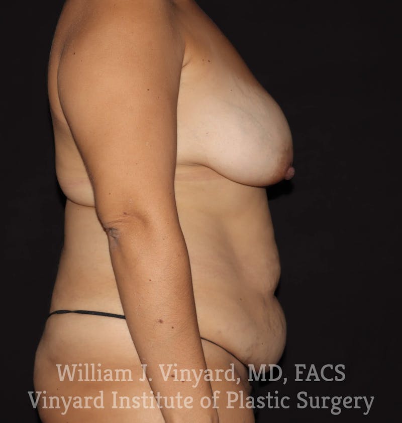 Breast Lift Before & After Gallery - Patient 169746166 - Image 5