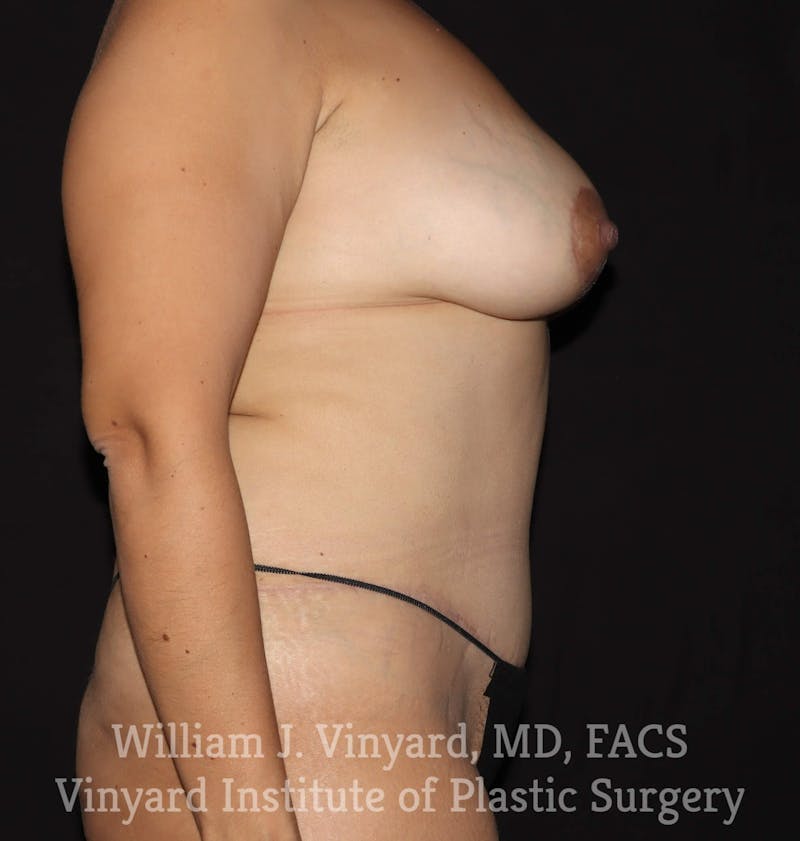 Breast Lift Before & After Gallery - Patient 169746166 - Image 6